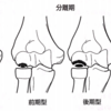 上腕骨小頭離断性骨軟骨炎の病期、臨床症状、理学所見