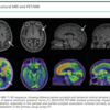 Balint症候群を生じたPosterior Cortical Atrophy｜神経内科の論文学習