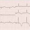 ECG-139：answer