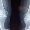 変形性膝関節症の原因と治療の落とし穴とは？｜福岡で腰痛のことなら未病リハビリセンターハレル