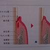 歯周ポケットって❓