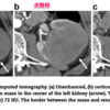 多発血管炎性肉芽腫症の腎腫瘤病変