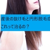 【産後】産後の抜け毛と円形脱毛症！これって治るの？