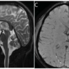 頭部振戦を生じた低セルロプラスミン症例-Clinical Reasoning｜神経内科の論文学習