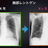 ECG-179：81才男性。８年間の心電図と胸部レントゲン変化です。