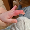 乳児の手の指がパンパンに腫れた話