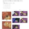 117回歯科医師国家試験【117A-53】保存修復学：グラスアイオノマー修復手順