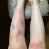【入院】わたしの潰瘍性大腸炎の症状と流れ②