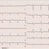 ECG-168：answer