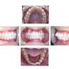 症例11～E-lineと乱ぐい歯の治療