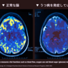 うつ病って、甘えじゃないの？ 仮病なんでしょ？ と疑われたら、この画像を見てもらってください。