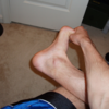 What Causes Plantar Fasciitis To Surface