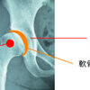 股関節がはずれそうになる。。。股関節のお話