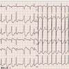 ECG-137：77才女性。入院中の頻拍発作です。