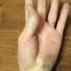 擦り傷の治しかた（キズパワーパッドで痛みを抑えて、傷痕も残らない）