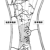 アキレス腱断裂　〜腱断裂と血流，手術，保存治療の違いについて〜
