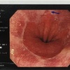 カンジダ食道炎と診断。心配ないけど