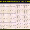 ECG-210：80才代女性。たこつぼの夜 ( a night in Takotubo Cardiomyopathy)