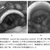 Vocal cord dysfunctionに対する口すぼめ吸気法