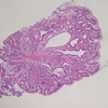 胃底腺ポリープ hyperplastic polyp, fundic type