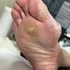 2ヶ月振りの角質ケア❗️