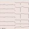 ECG-127：answer