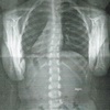 子供の背骨の曲がり『脊柱側弯症』の改善例