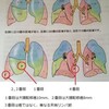 大腸癌（直腸癌）対策メモ Stage IV