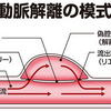 大動脈解離　ステントグラフト内挿入術