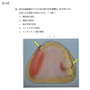 116回歯科医師国家試験【116A-39】義歯：クラスプ付き咬合床編