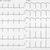 【ECG-005】：78才女性。外来患者(stable state)