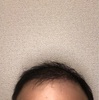 術後3か月〜