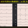 ECG-246：60才代男性。夜の胸痛です。