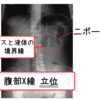 腹部単純レントゲンはいつ取るか