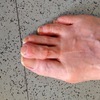 Hammer Toe Relief