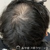 AGAの治療例