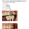 118回歯科医師国家試験【118C-61】歯冠補綴学：レジン前装冠
