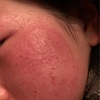 娘のアレルギーアトピー　薬ステロイドを使わず私がやったこと