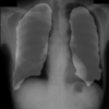 【GluonCV】胸部X線写真に写っている肺をセグメンテーション