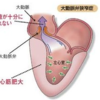 大動脈弁狭窄症で２音減弱し、大動脈弁閉鎖不全症で２音亢進する理由