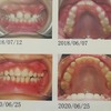 歯の矯正　経過報告