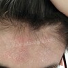 中学生のアトピー発症体験談③脱ステロイドと自力治療の沼…悪化を招いた病院不信