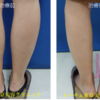 ふくらはぎボトックス（Botox）注射でししゃも脚を細く