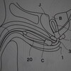 OKプロステートチップ解説393-チップレスなプロステートチップの特許申請すませました