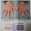 ヘバーデン結節