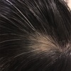 円形脱毛症その後