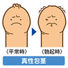 人類皆包茎