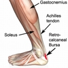 Identifying Posterior Calcaneal Spur