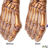 Bunions Symptoms