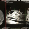 MRIの結果と、治療方針